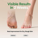 60% Urea Cream with 2% Salicylic Acid, Urea Cream 60 Percent for Feet & Hands, Maximum Strength Moisturizer Foot Lotion for Dry Cracked Heels Feet Knees Elbows Hands, Callus Remover, 10.1 fl oz — 3