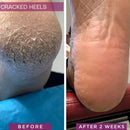 Rapid Crack Repair Cream, 25% Urea with Lactic Acid, Restores Cracked Heels and Diabetic Feet, Post-Surgery Scar Care, Fragrance-Free Barrier Cream, 3 oz — 3
