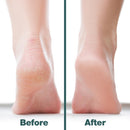 Probelle Double Sided Multidirectional Nickel Foot File Callus Remover - Immediately Reduces calluses and Corns to Powder for Instant Results, Safe Tool (White) — 4