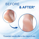 60% Urea Cream Stick with 2% Salicylic Acid, Maximum Strength Foot Cream Stick for Dry Cracked Heels & Calluses, Rapidly Softens Thick Skin - Non-Greasy & Fast Acting - 2-Day Visible Results — 5