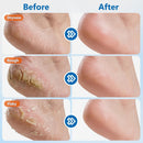 Dmsky 4 Packs Urea Foot Cream 60% Urea with 2% Salicylic Aci,Urea Foot Care Stick,Strength Foot Cream Moisturizer for Dry Cracked Feet, Knees, Elbows, Hands,Moisturizes and Hydrates the Dry Skin — 2