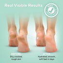 Lavinso Urea Cream 40 Percent for Feet with Maximum Strength - Foot Cream for Calluses and Dry Cracked Heels - Rough Skin Repair for Men and Women — 3
