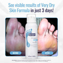FOOTLOGIX Very Dry Skin Formula Foot Mousse – Urea, Co-Q10, Aloe Vera & Vitamin E | Moisturizing Foot Mousse for Dry & Rough Feet | Fragrance-Free, Non-Greasy | 4.23 fl oz — 3