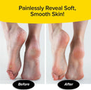 PedEgg Foot File, Painless Callus Remover, Mess-Free, As Seen on TV — 5