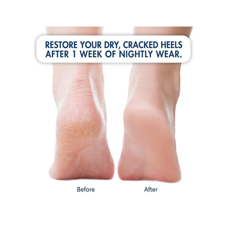 Amazon.com : Cracked Heel Treatment Repair Socks - Ohtomber 5 Pairs Heel  Softener Socks for Dry Cracked Feet Heels, Foot Care Toeless Pedicure  Moisturizing Socks, Dry Feet Silicone Gel Socks Overnight :