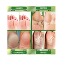 PurOrganica Urea 40% Foot Cream No Pumice Stone  Callus Remover  Moisturizes & Rehydrates Thick Cracked Rough Dead & Dry Skin For Feet Elbows and Hands