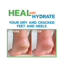 StrappyFeet Urea 40% Cream plus Salicylic Acid 2% Foot Cream - Softens and Moisturizes Rough Thick Dry Cracked Feet and Heels - with Aloe Vera Shea Butter and Tea Tree Oil